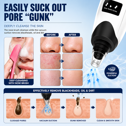 Blackhead Remover Vacuum Kit – Deep Pore Cleansing Made Easy